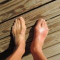 Feet - Gout