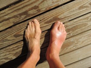 Feet - Gout